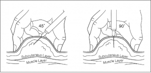 Subcutaneous Injection