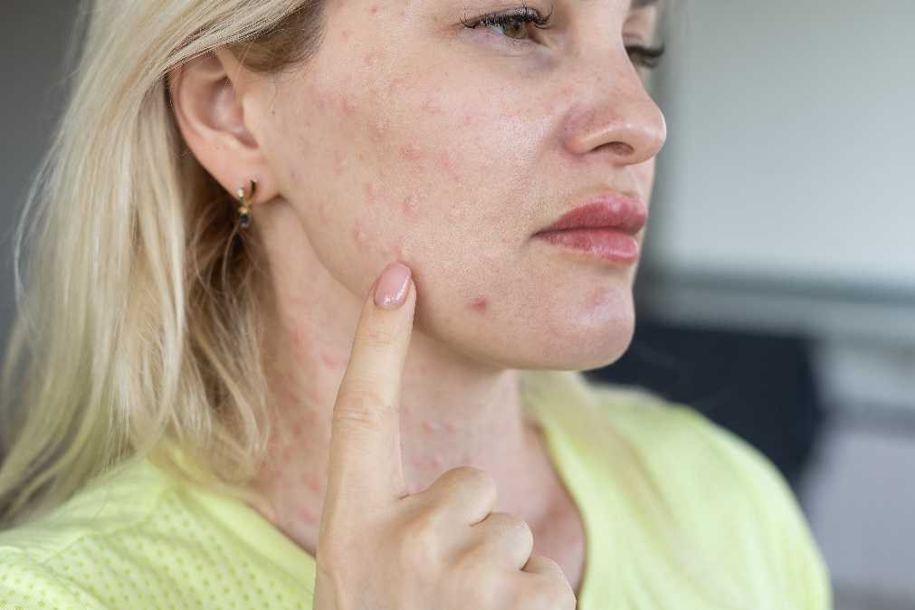Managing acne during testosterone replacement therapy