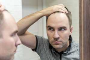 testosterone therapy hair loss 2