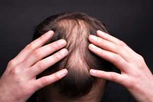 testosterone therapy hair loss 3