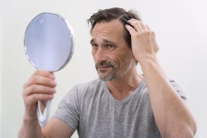 testosterone for hair loss 3