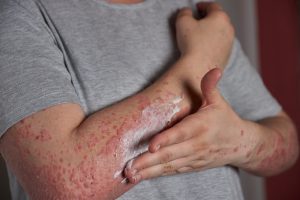 trt and psoriasis 3