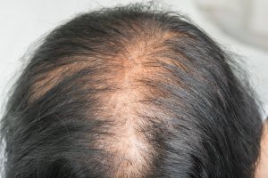 trt and hair loss 2