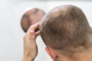 trt and hair loss 3