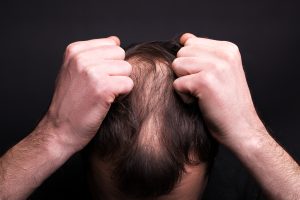 trt and hair loss 4