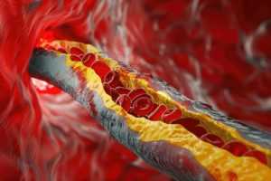 testosterone therapy and cholesterol 3