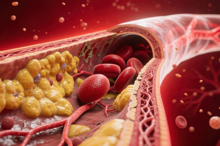 trt and high cholesterol 1