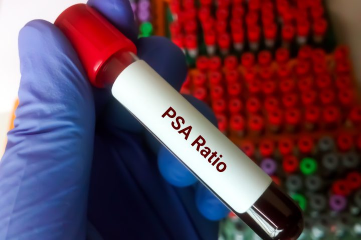 can testosterone therapy increase psa 1