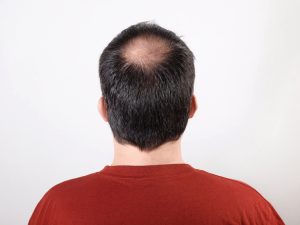 testosterone therapy baldness 2