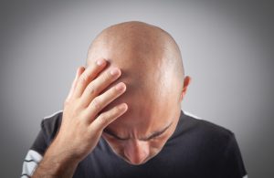 testosterone therapy baldness 4